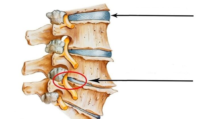 spinal injury with cervical osteochondrosis