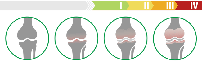 Clinical stages of arthrosis of the knee joint (degree of arthrosis of the knee joint)