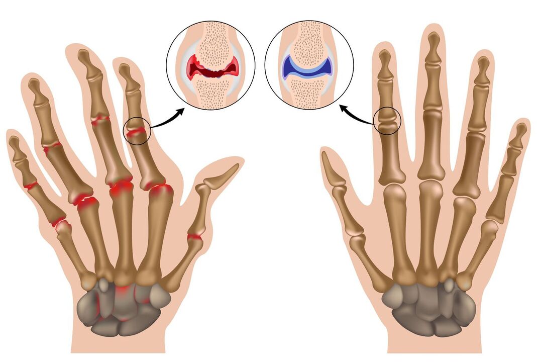 Healthy and polyarthritis-affected hand joints