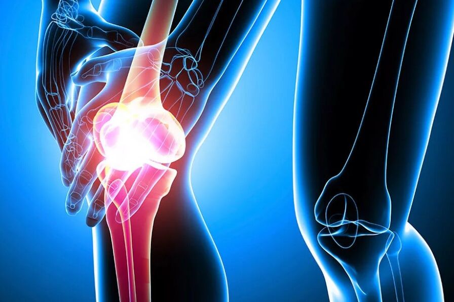 Arthrosis of the knee