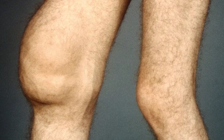 Post -traumatic arthrosis of the knee joint