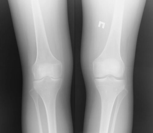 The radiograph of the knee joint