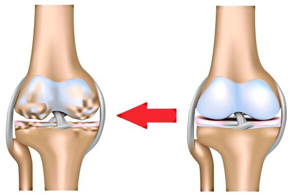 Healthy joint and arthrosis
