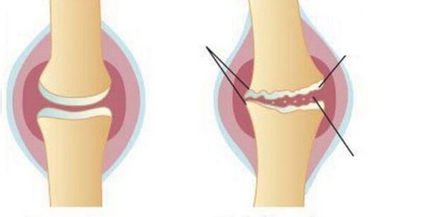 Washing cartilage