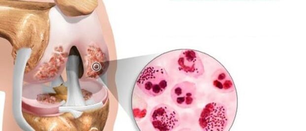which leads to the development of arthrosis