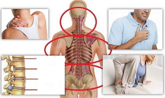 Places of disease for osteochondrosis
