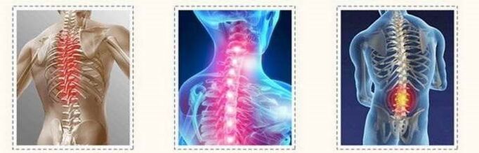 osteochondrosis spinal lesions