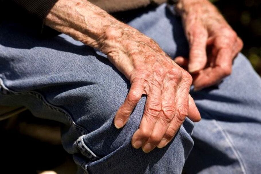 Arthrosis is an age-related disease that occurs in older people
